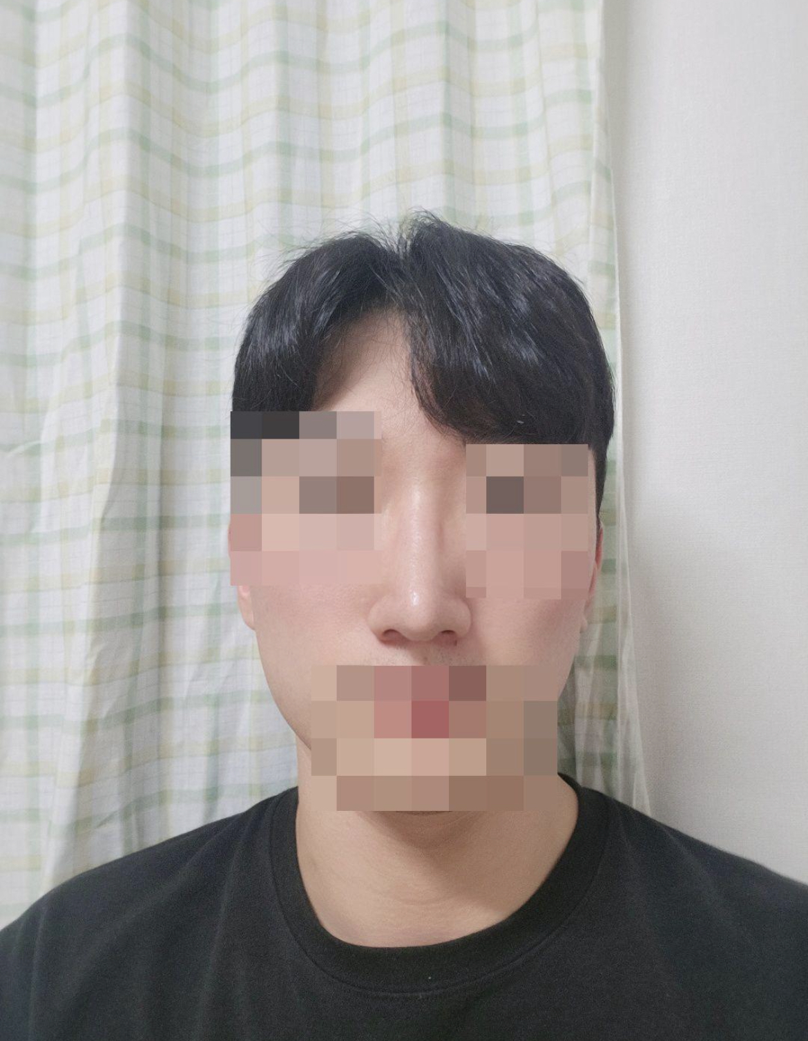 수술후기이미지