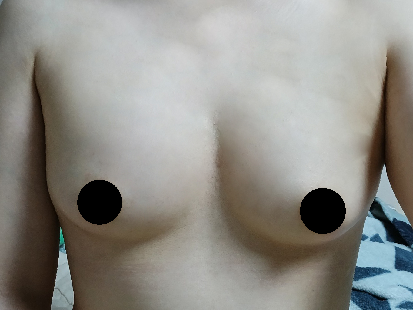 수술후기이미지