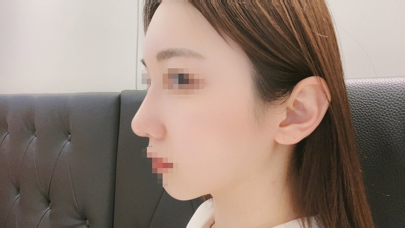 수술후기이미지