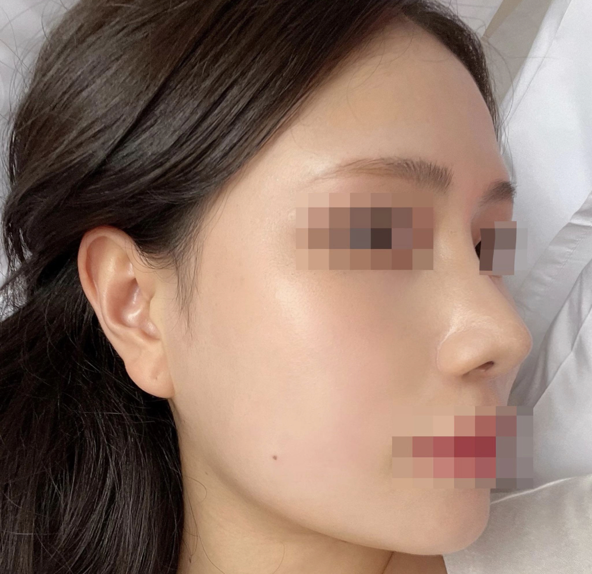 수술후기이미지