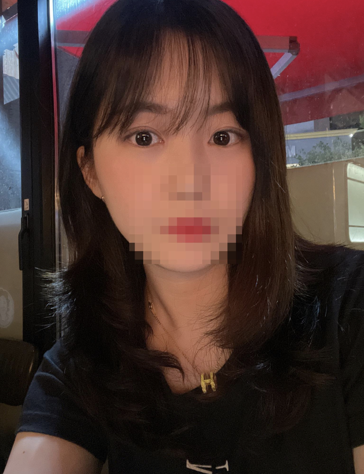 수술후기이미지