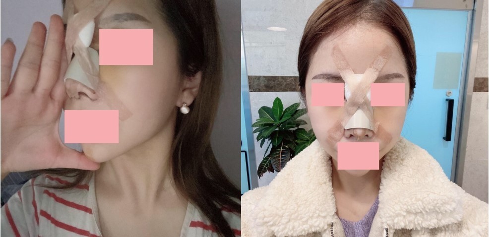 수술후기이미지