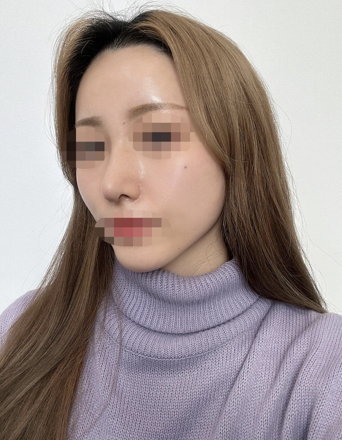 수술후기이미지