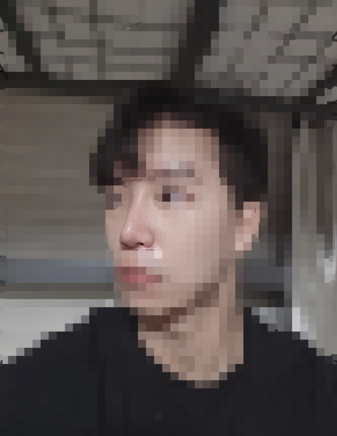 수술후기이미지