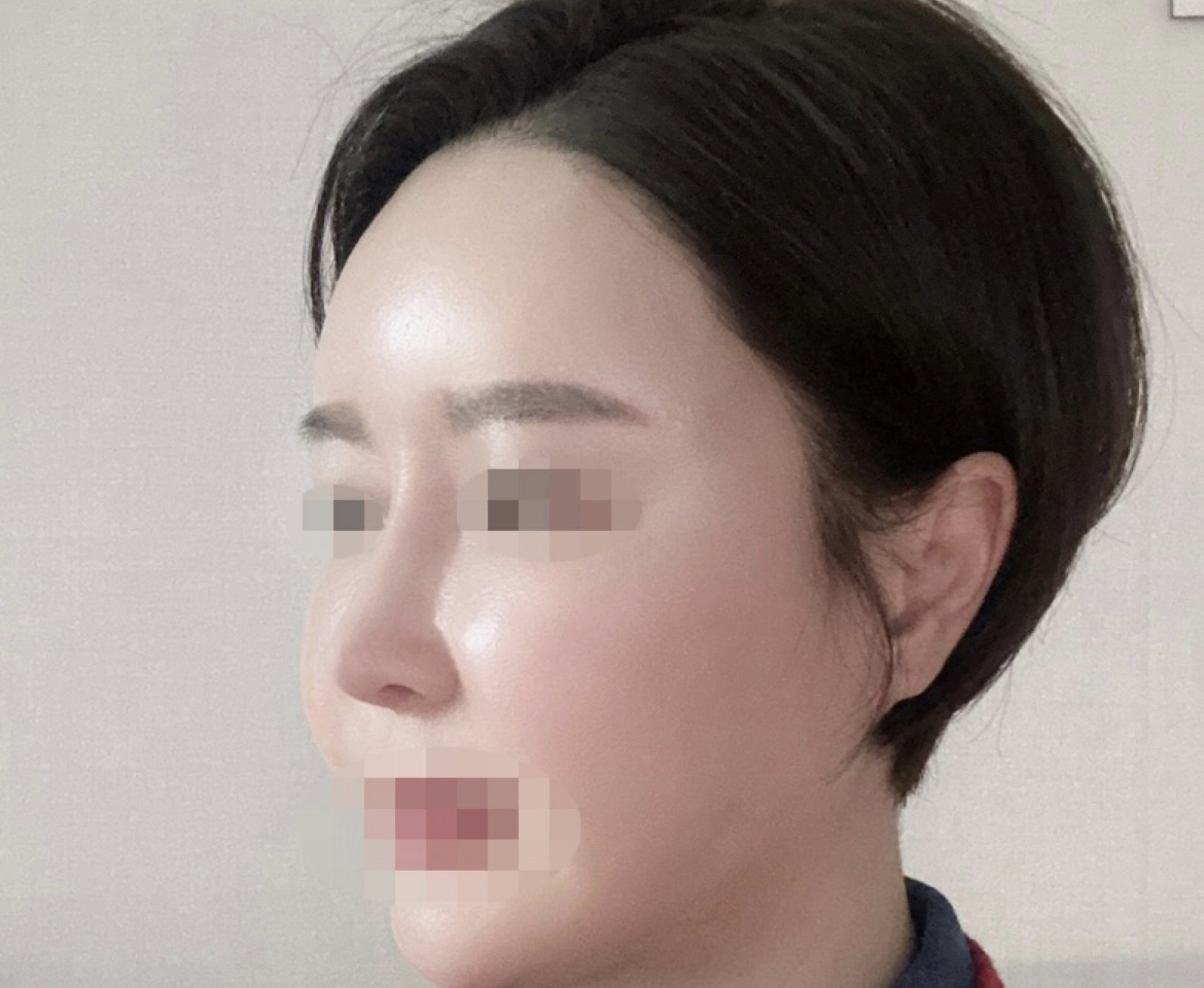 수술후기이미지