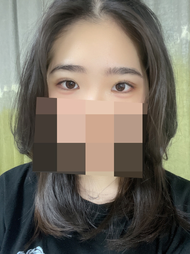 수술후기이미지