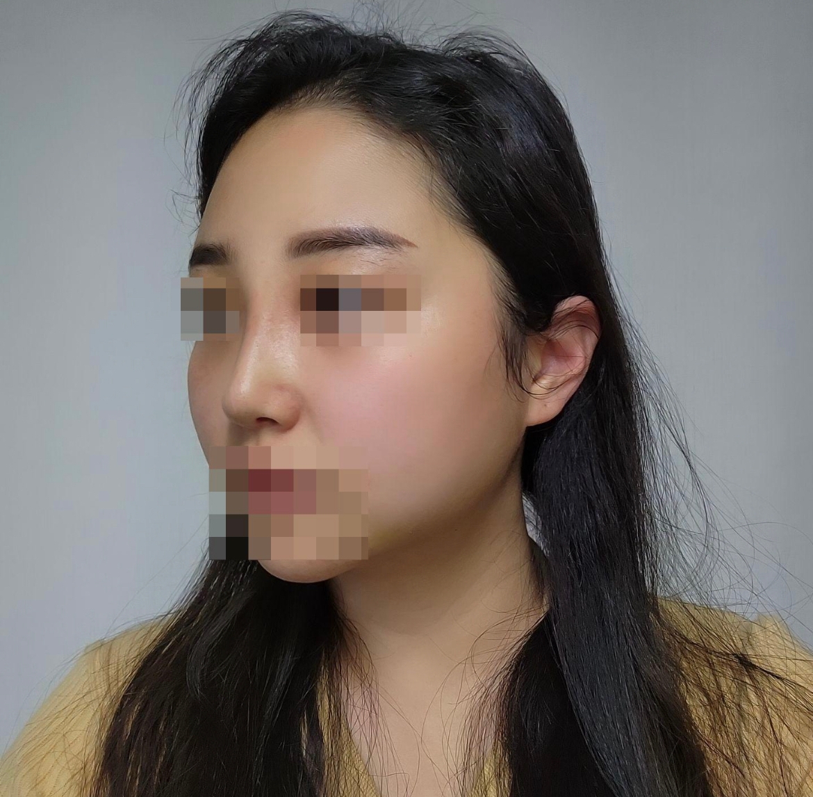 수술후기이미지