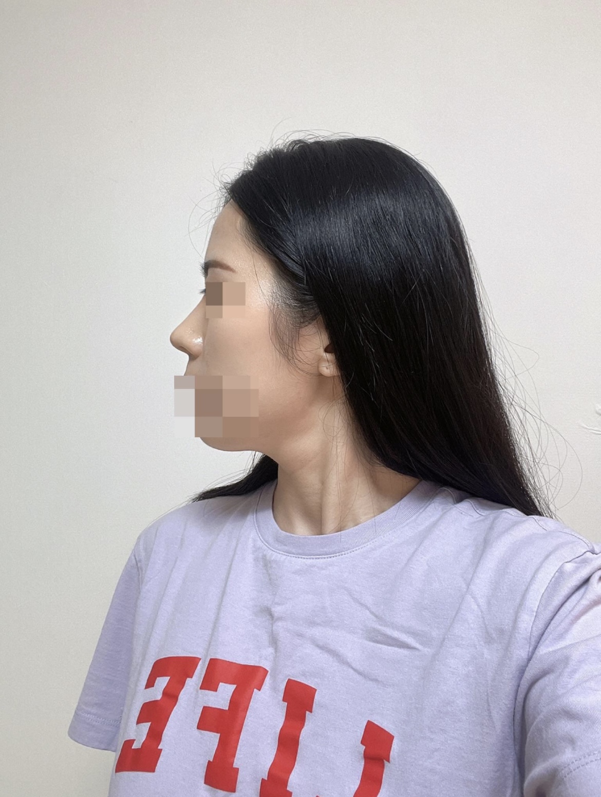 수술후기이미지