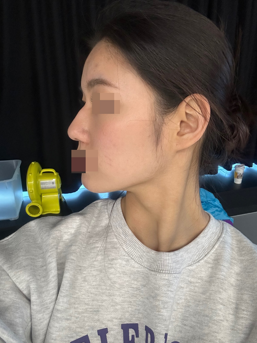 수술후기이미지