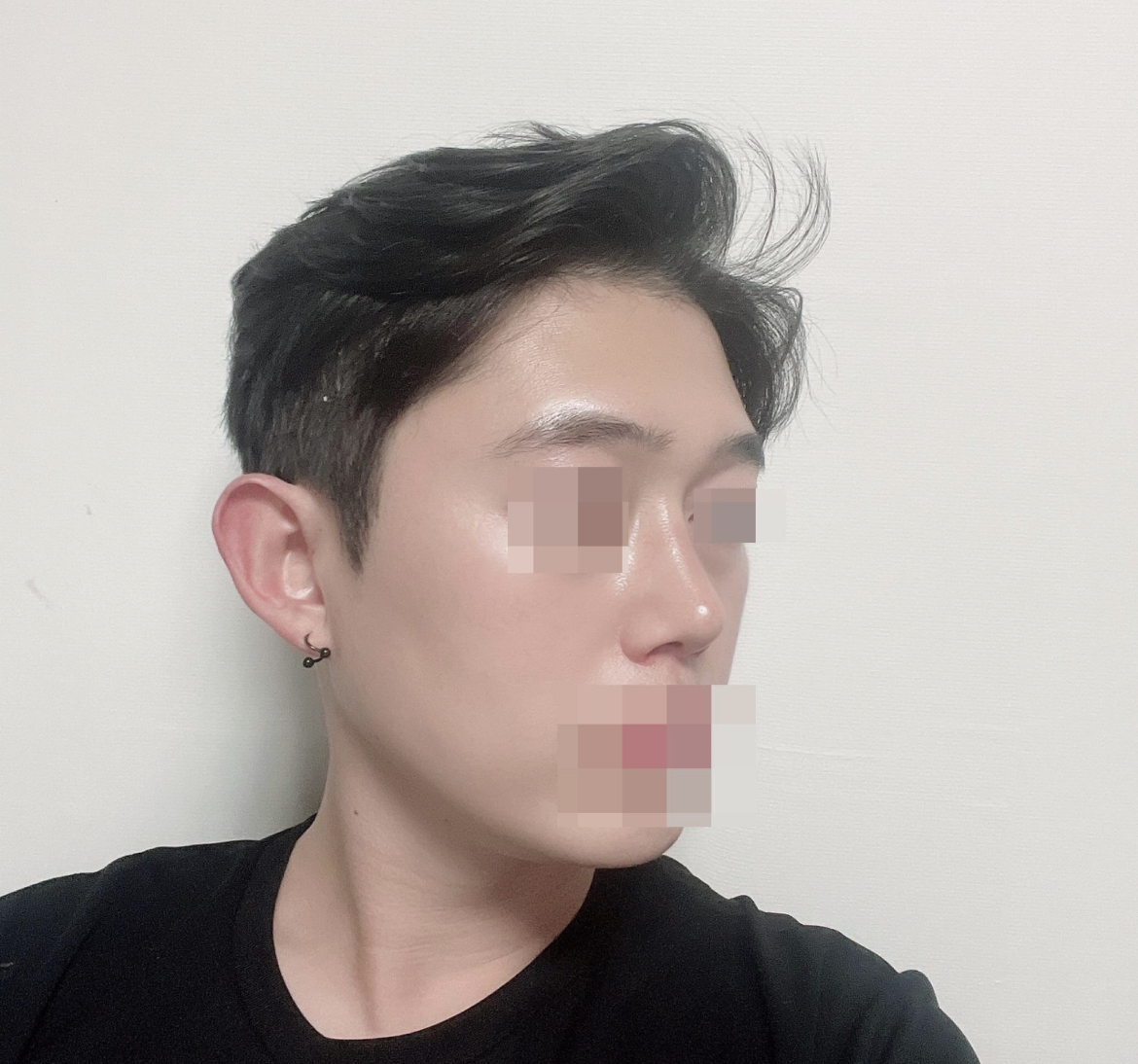 수술후기이미지