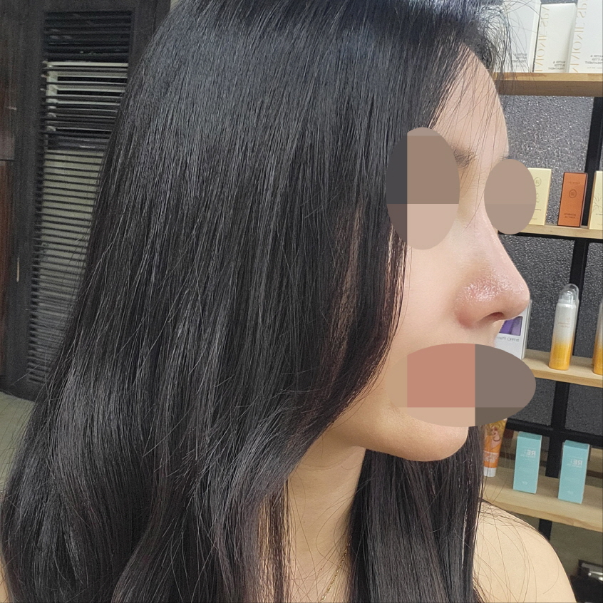 수술후기이미지