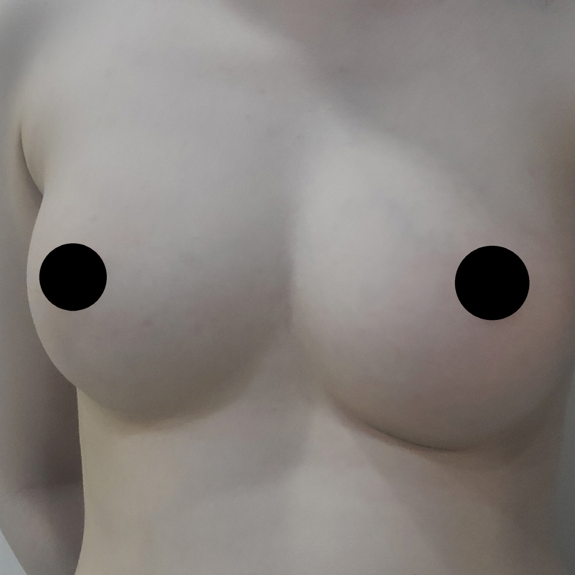 수술후기이미지