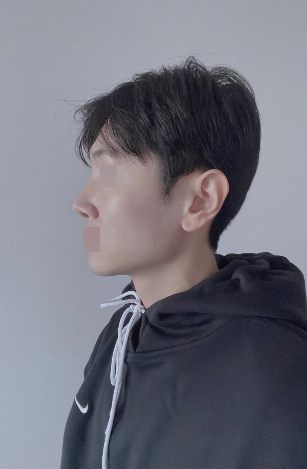 수술후기이미지