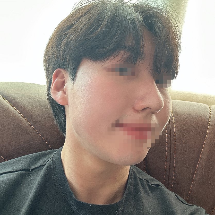 수술후기이미지