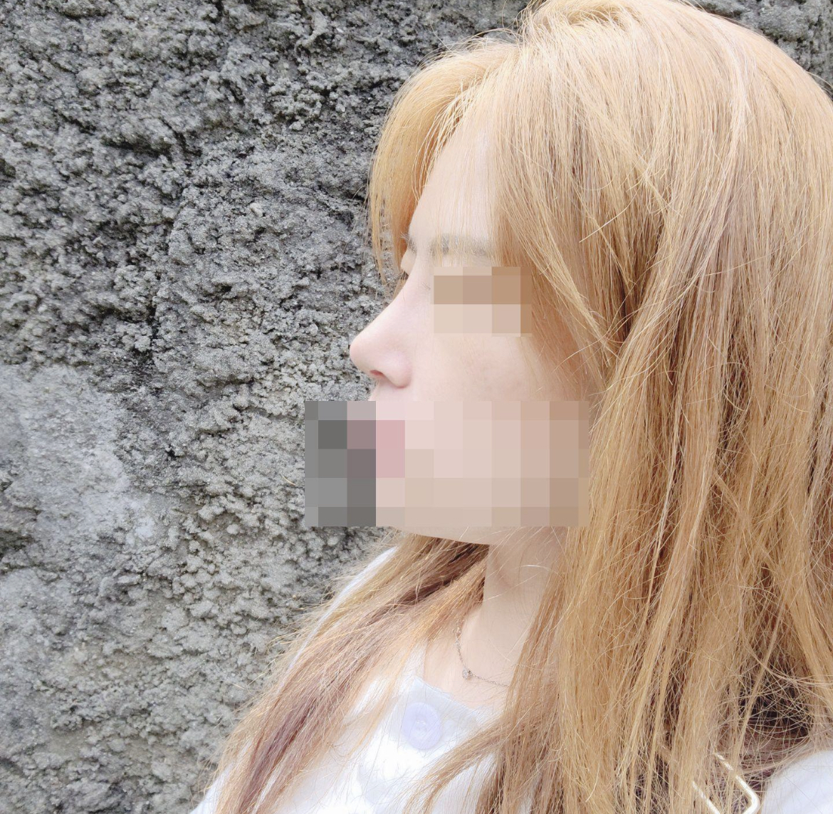 수술후기이미지