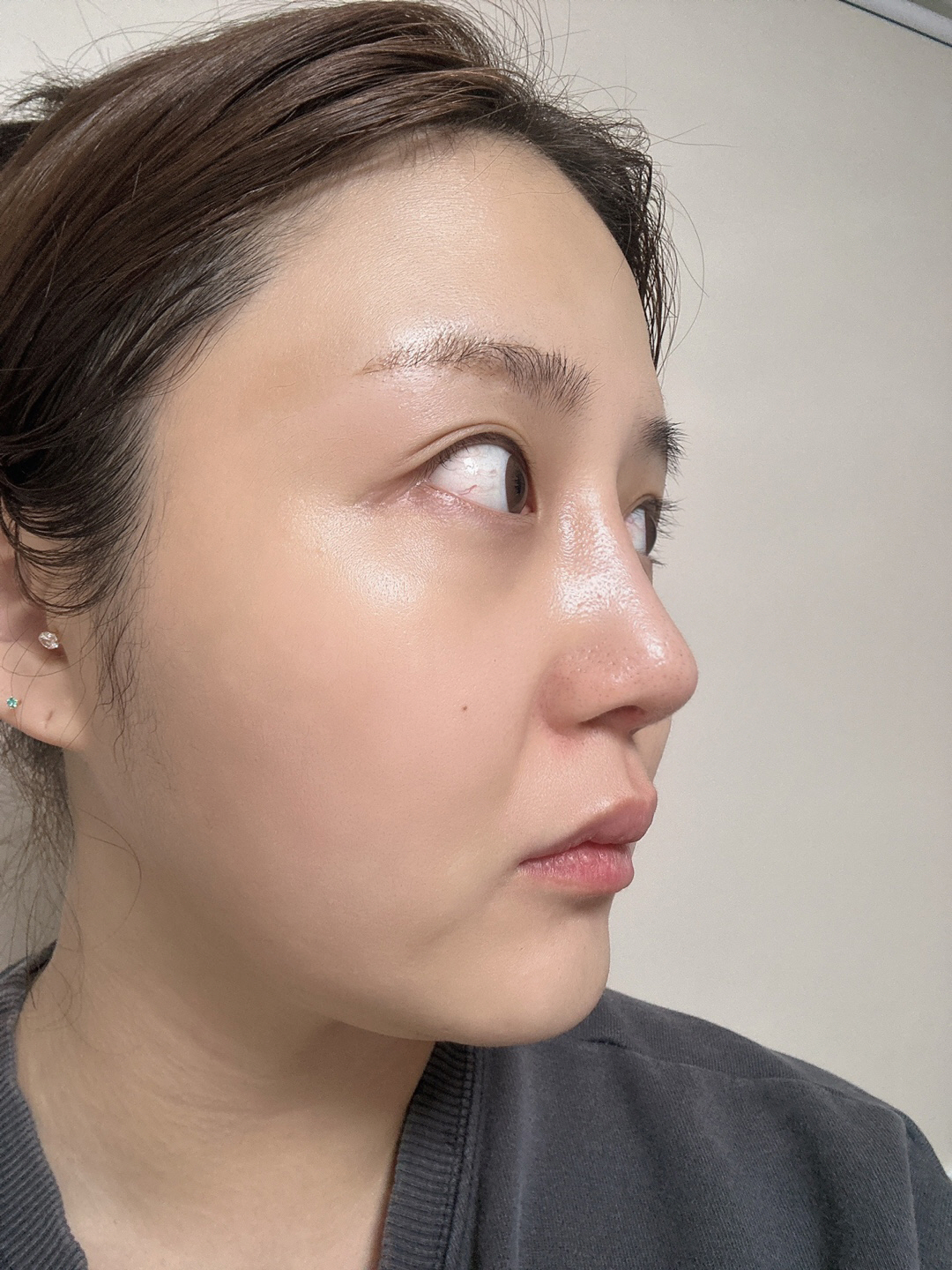 수술후기이미지