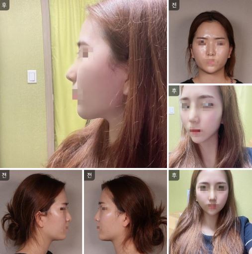 수술후기이미지