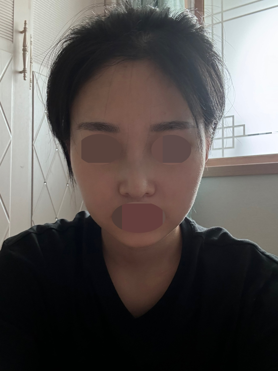 수술후기이미지