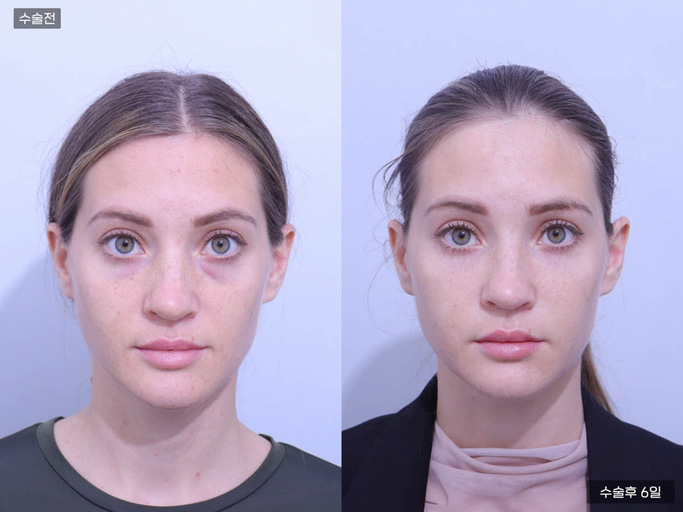 PRP 눈밑 + 앞볼 + 팔자