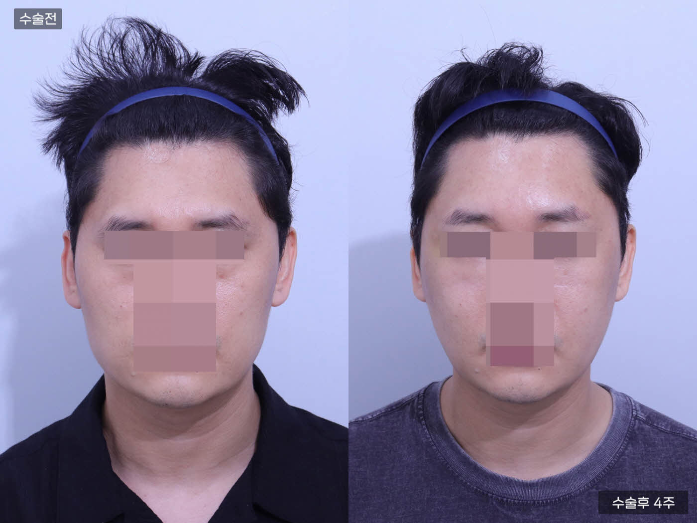 광대뼈 + 사각턱