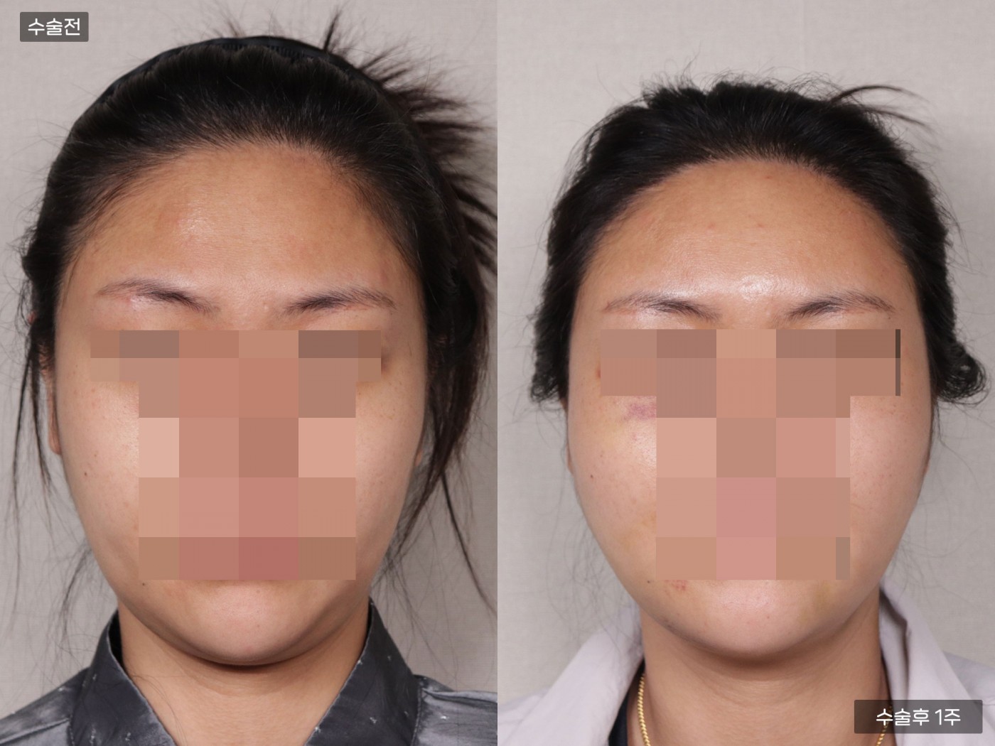 모발이식 [절개 모발이식(3000모)]