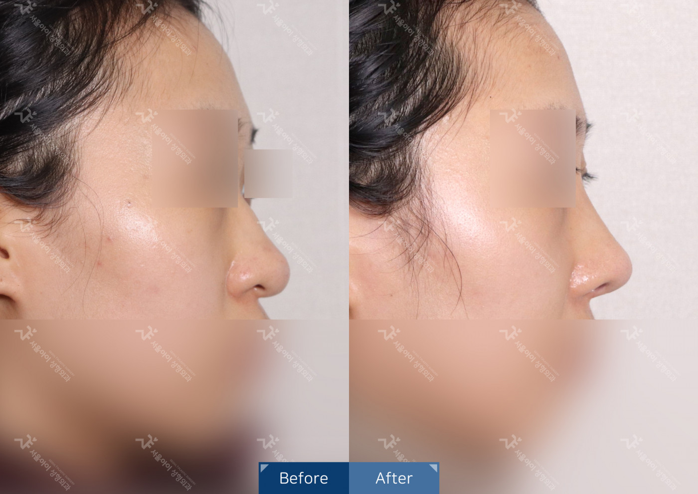 코성형 [융비술&코끝조각술(비중격)+복코교정]