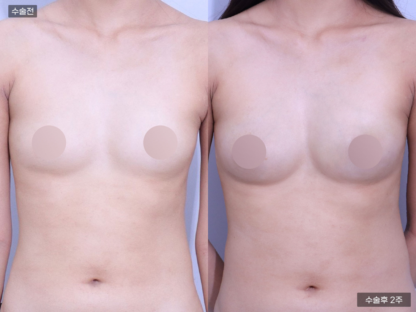 가슴성형 [가슴지방이식(200CC + 200CC)]