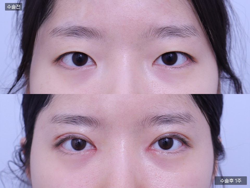 부분절개 + 눈매교정 + 앞트임