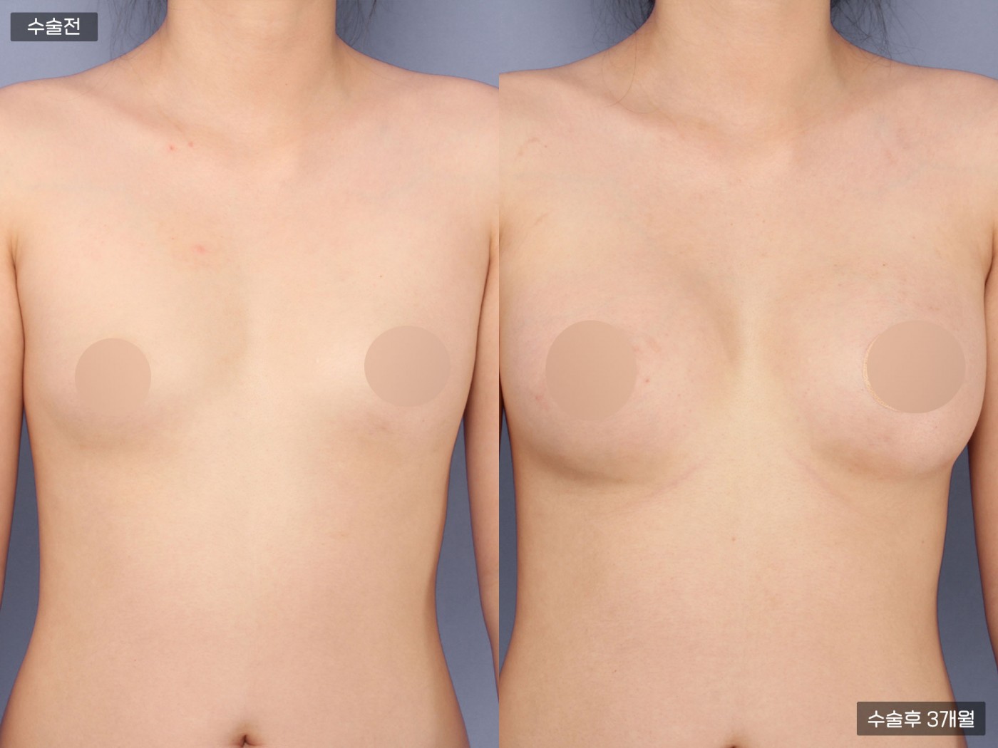 가슴성형 [가슴지방이식]