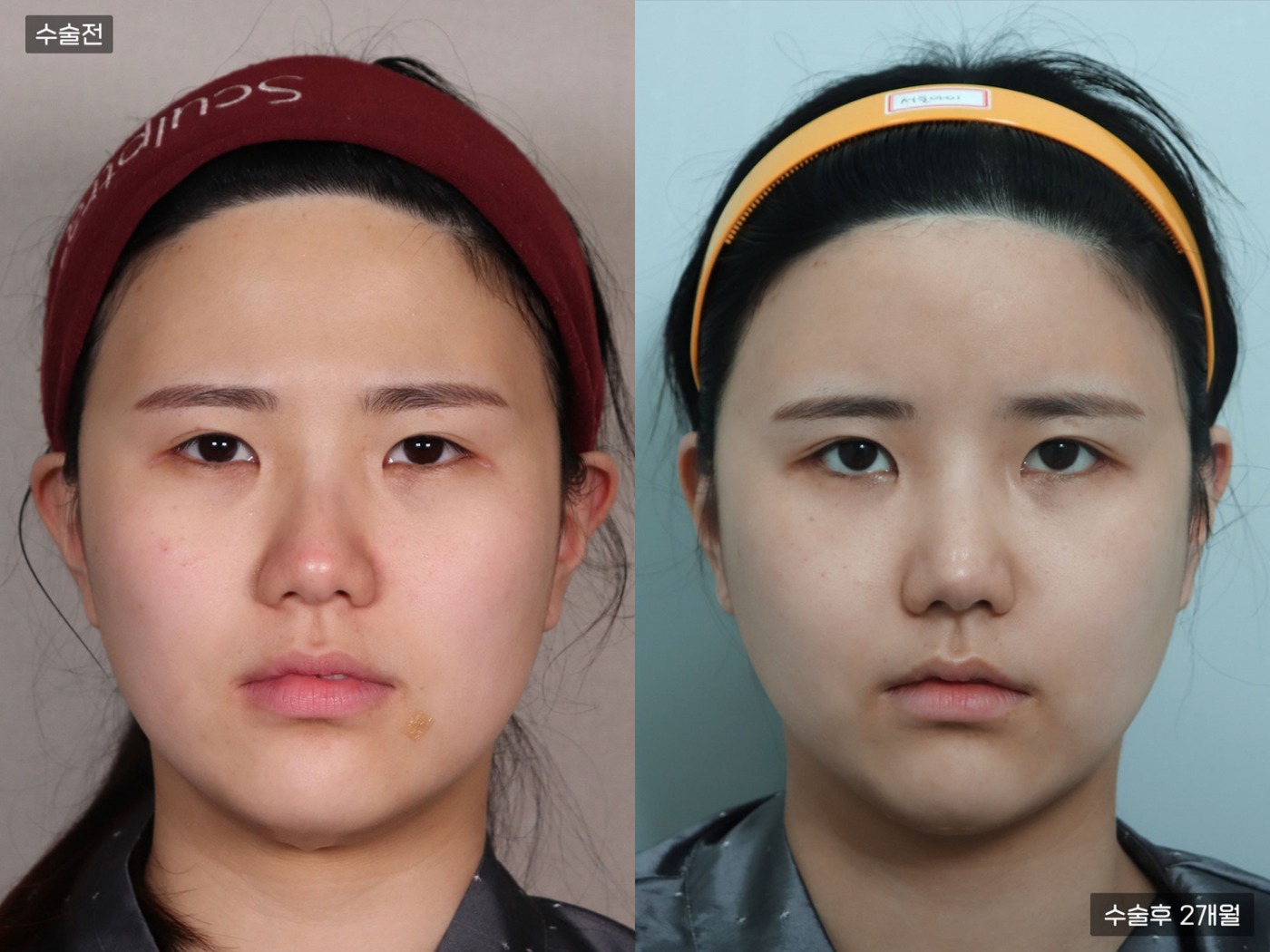 지방이식 [이마]