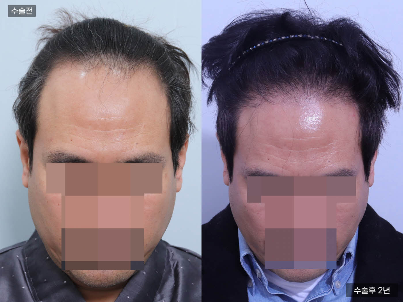 모발이식[비절개 모발이식(3000모)]