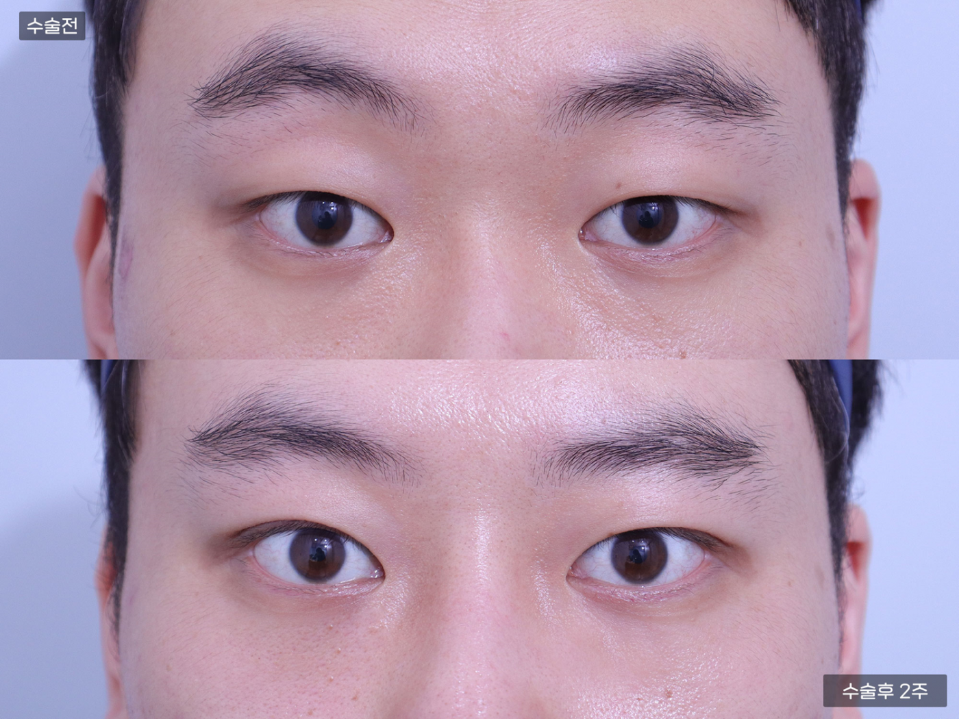 눈성형 [자연유착 쌍꺼풀]