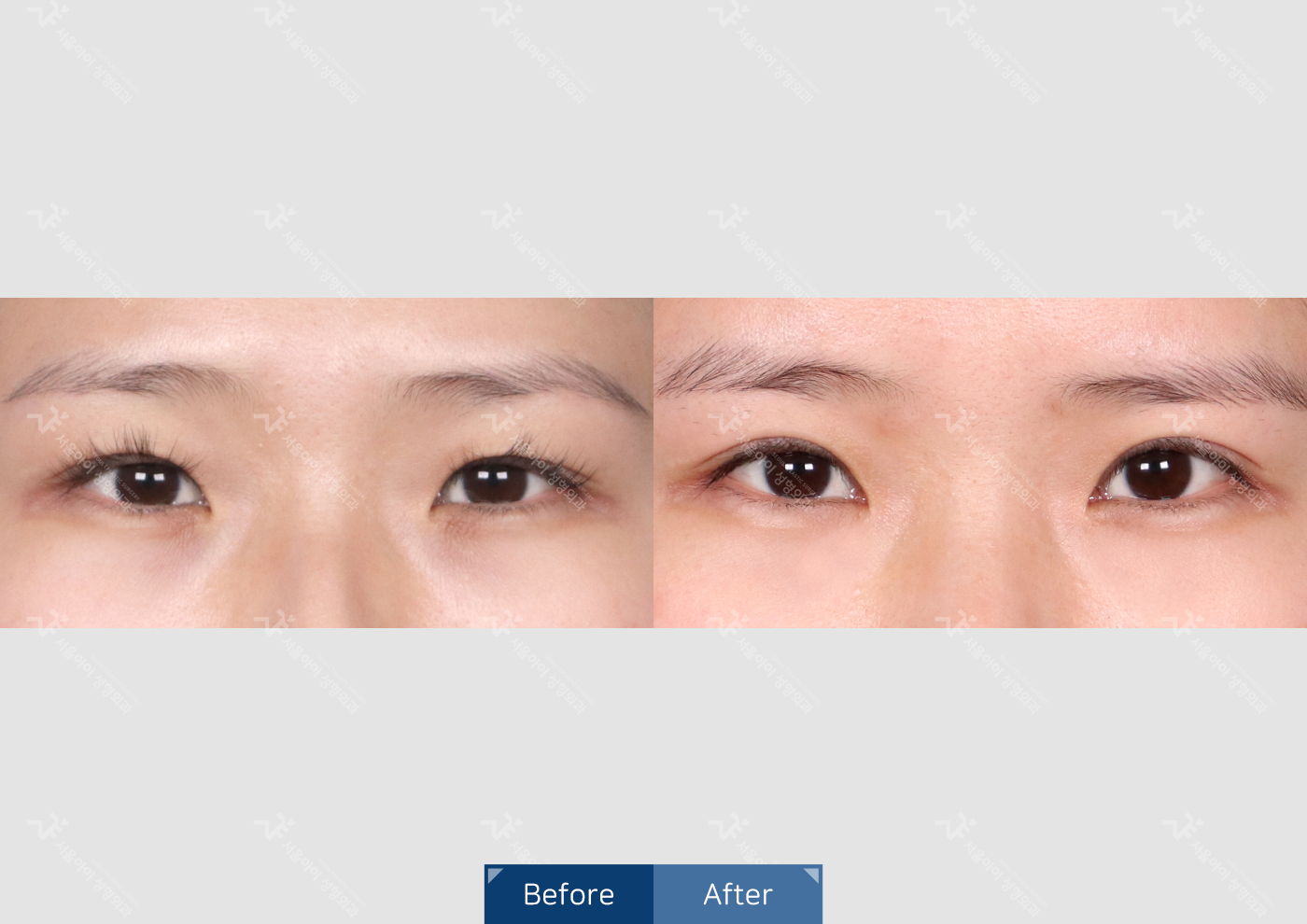 눈성형 [자연유착 쌍꺼풀]