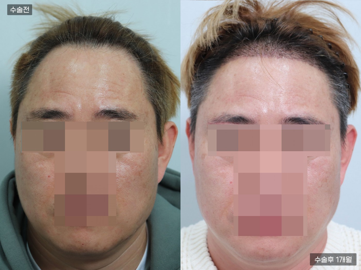 모발이식 [절개 모발이식(3000모)]