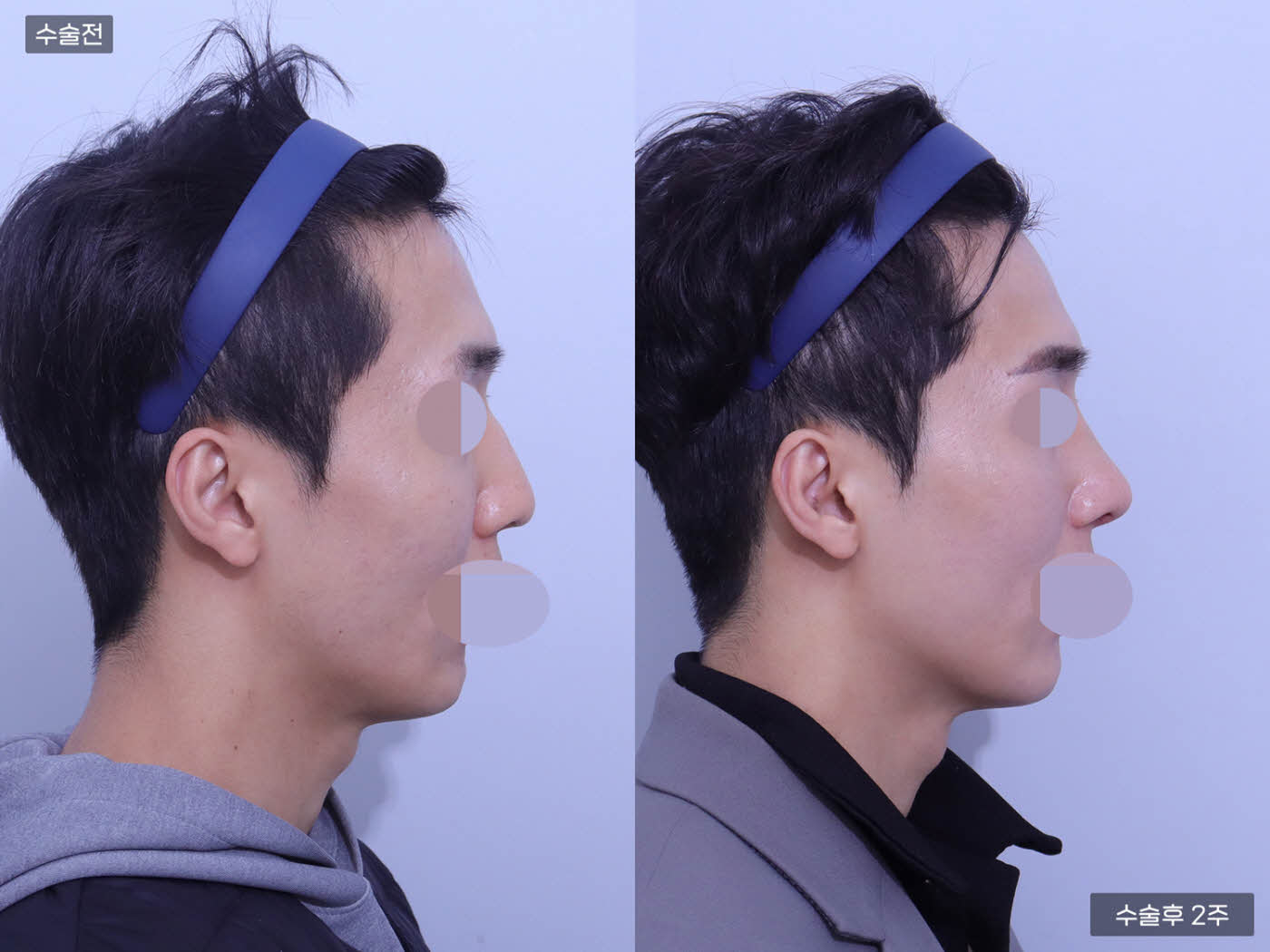 코끝(비중격) + 매부리코