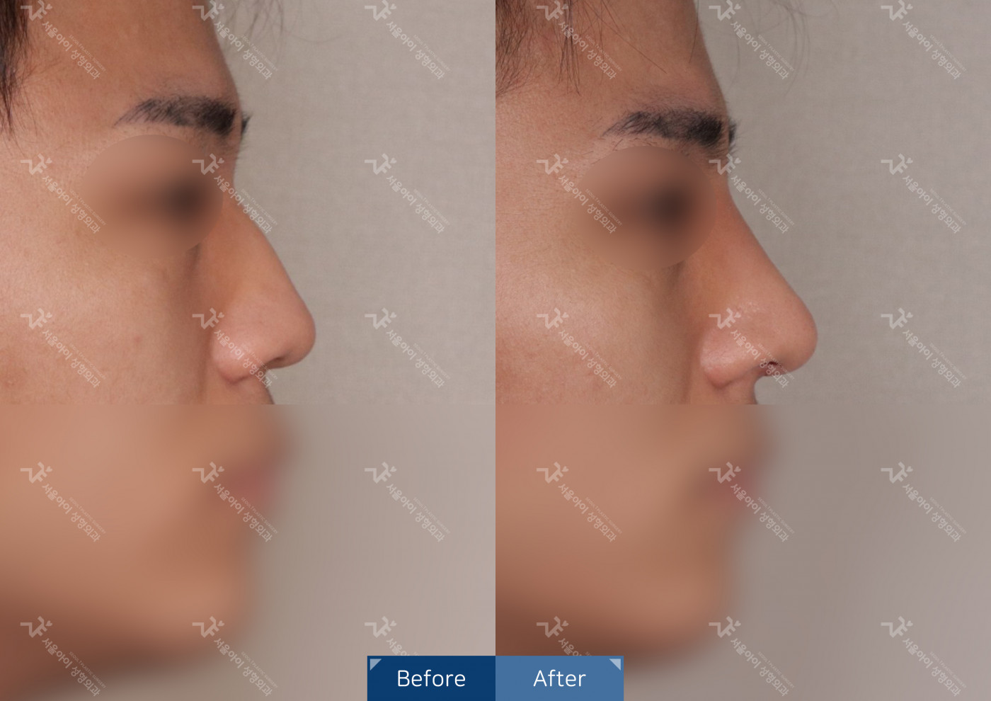 코성형[코끝조각술+비중격+복코교정술+짧은코교정]