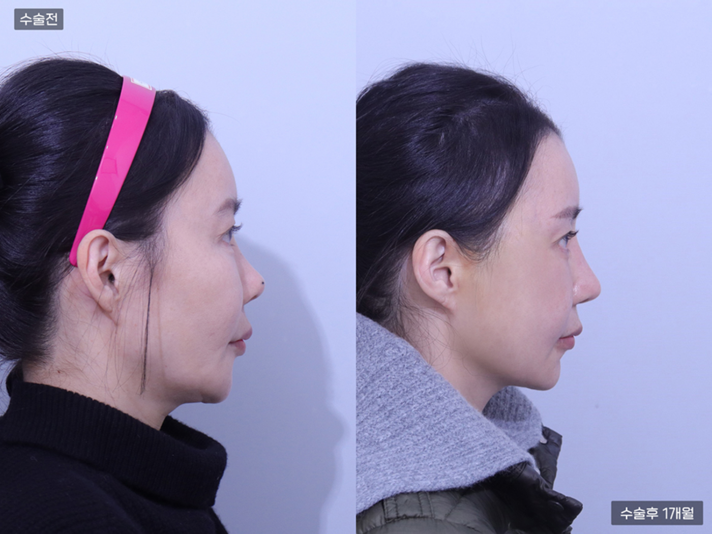 코재수술 + 코끝