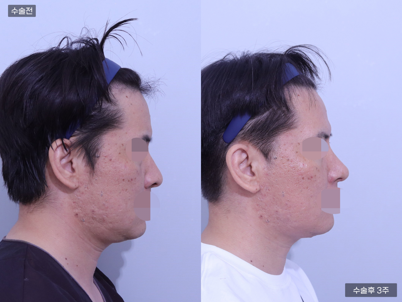 코끝 + 매부리코 + 복코