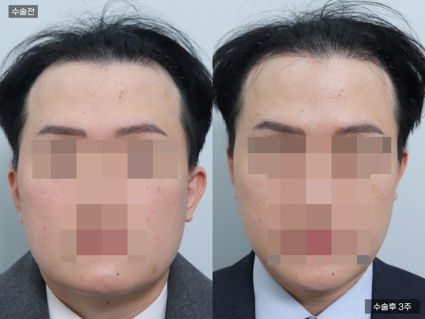 모발이식[절개 모발이식(2000모)]