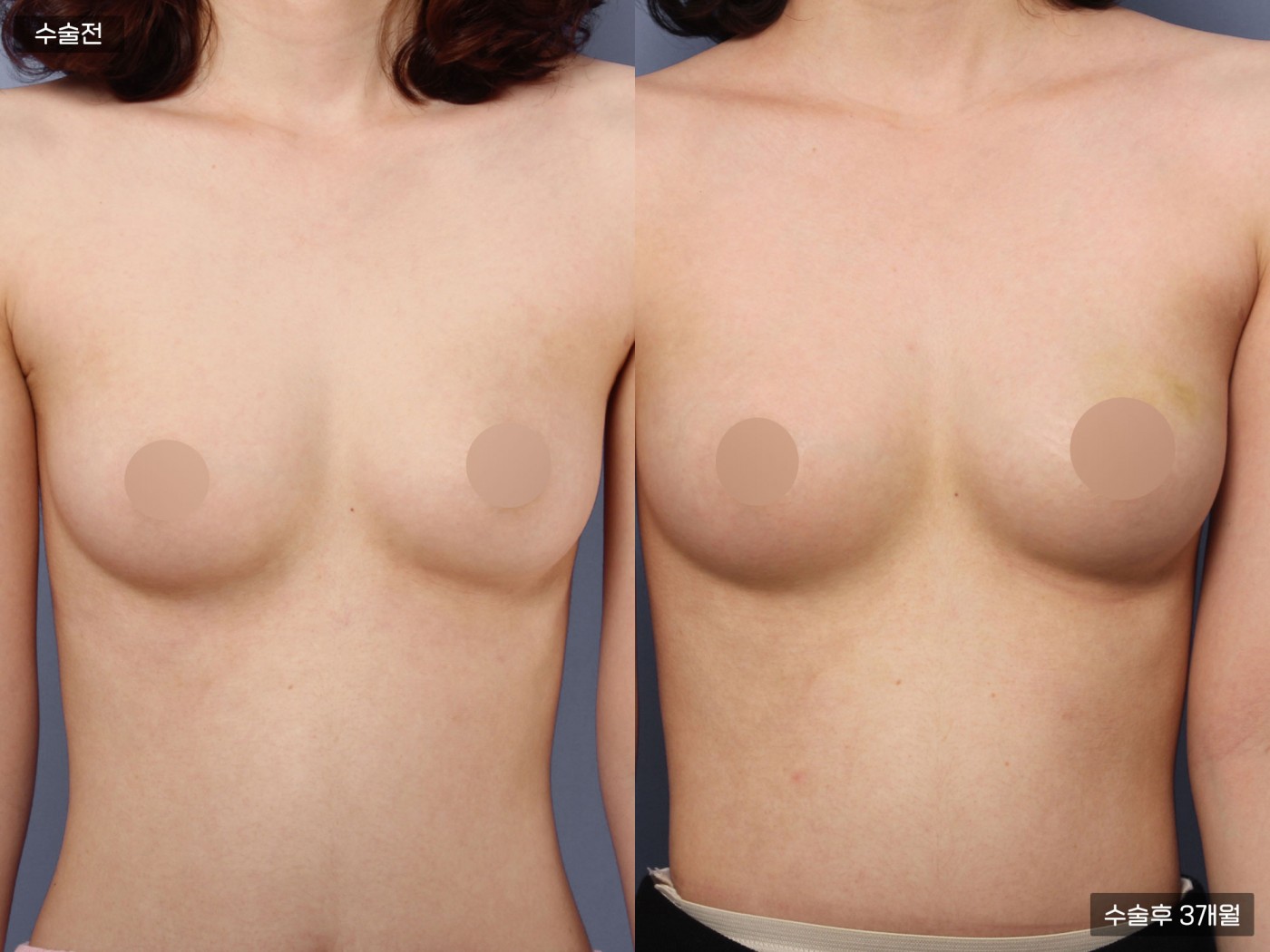 가슴성형 [가슴지방이식]