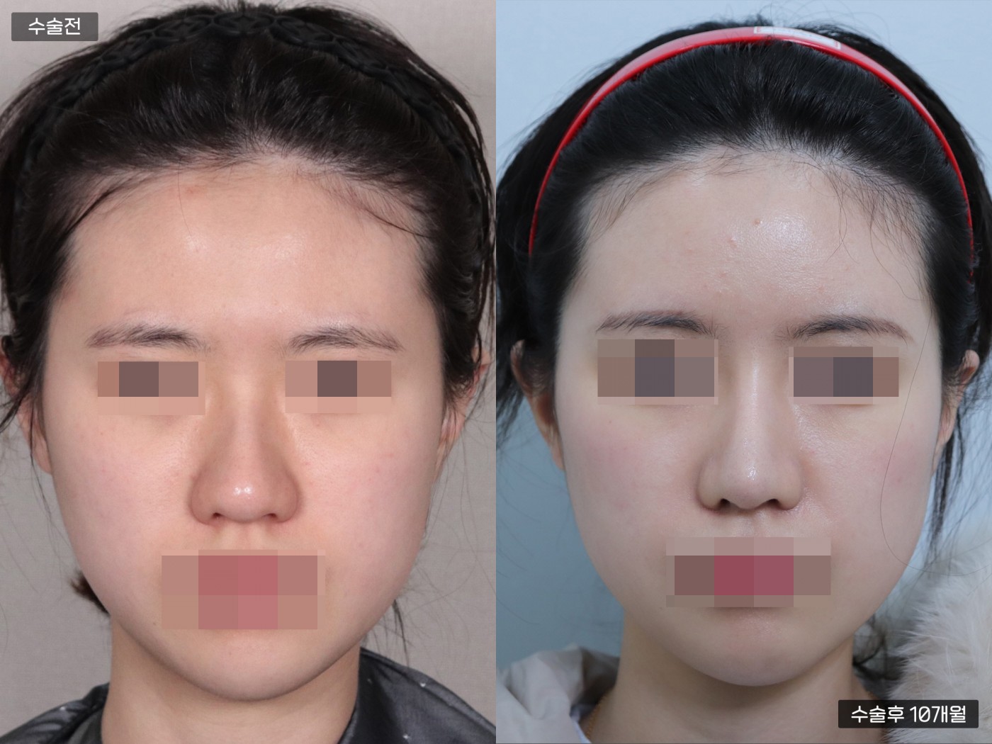 지방이식 [이마]