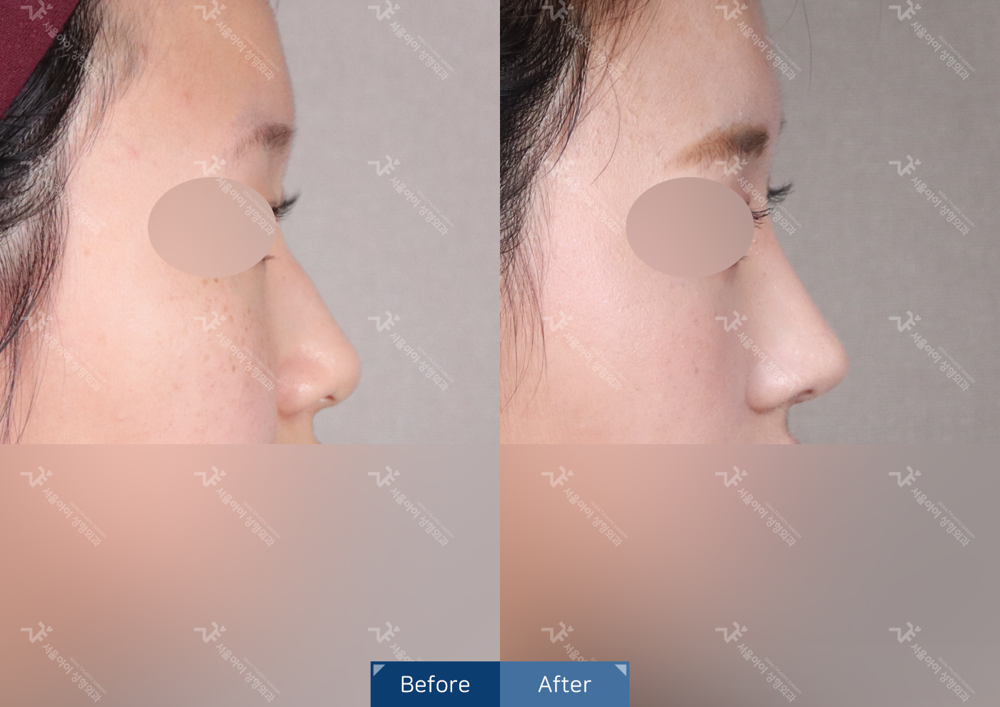 코성형[기능3종 + 미용코]