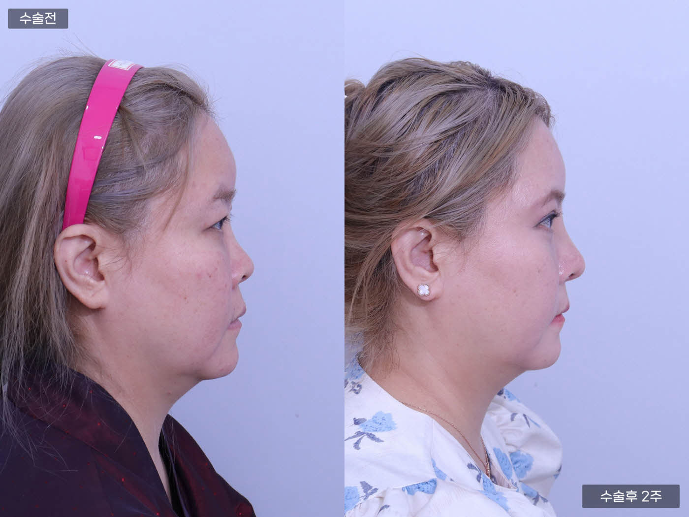 코끝교정 + 매부리코 + 콧볼축소