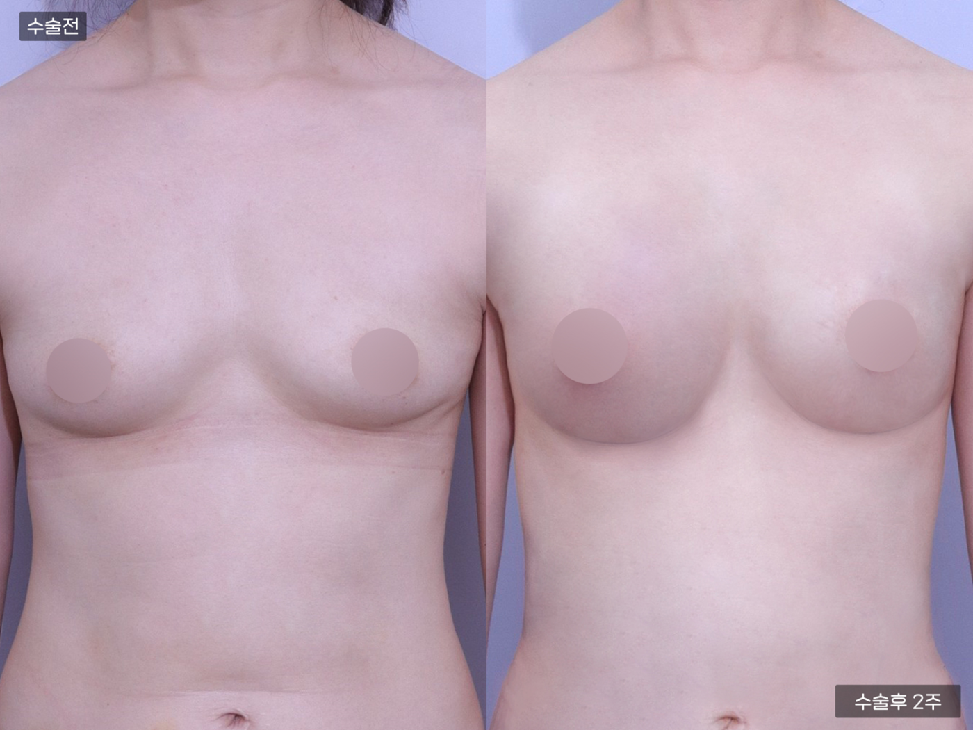 가슴성형 [가슴지방이식(300CC + 300CC)]