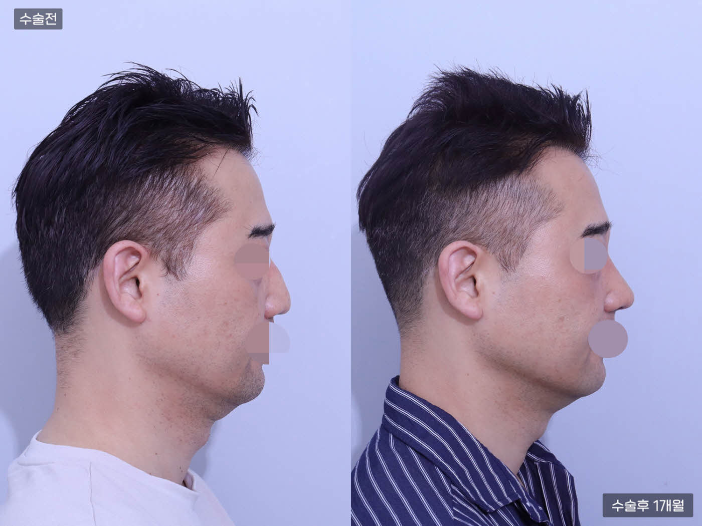 코끝 + 복코 + 매부리코