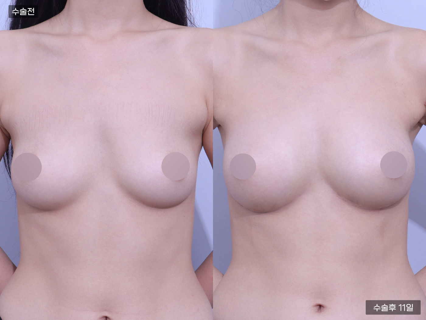 가슴성형 [가슴지방이식(200CC + 200CC)]