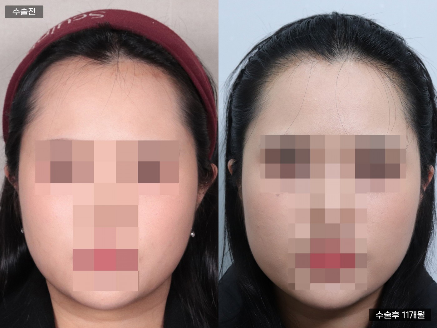 모발이식 [절개 모발이식(3000모)]