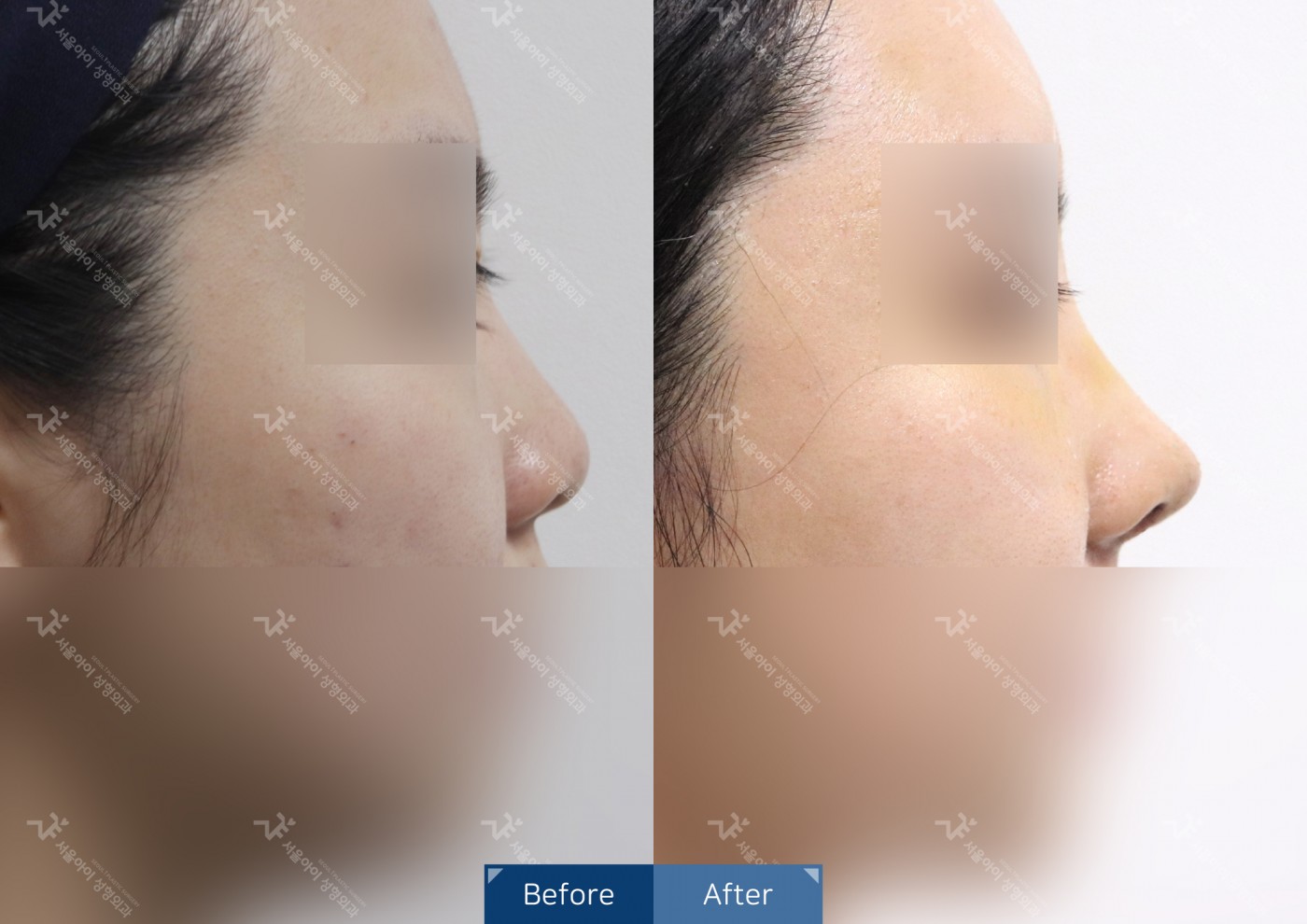 [코성형] 융비술&코끝조각술(비중격)+복코교정+축비술