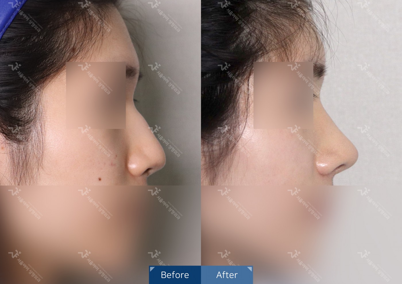 [코성형] 코끝조각술(비중격)+복코교정+매부리코교정+콧볼축소술