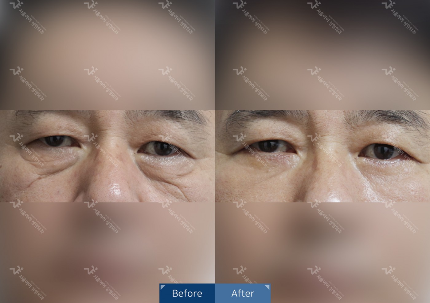 눈성형 [하안검]